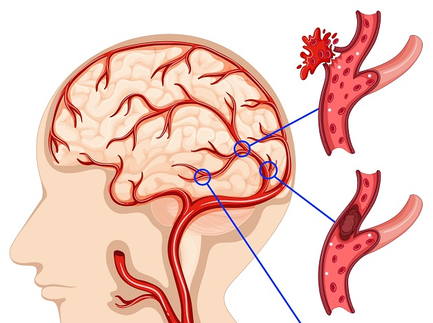 Vì sao đột quỵ cần được phát hiện sớm?