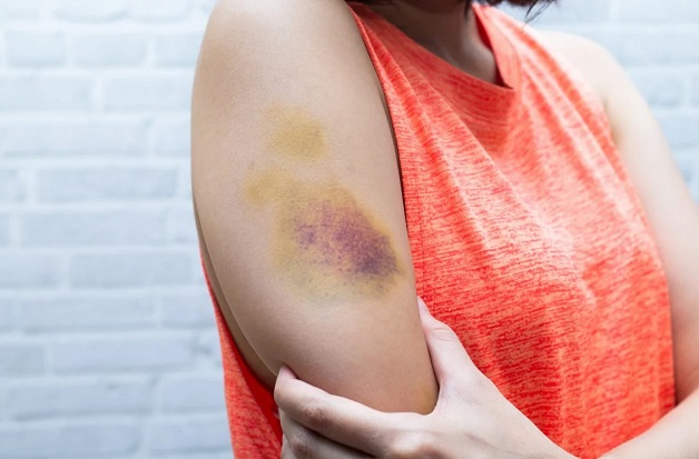 Một số trường hợp tiểu cầu của người bệnh có thể phản ứng với tiểu cầu được truyền.