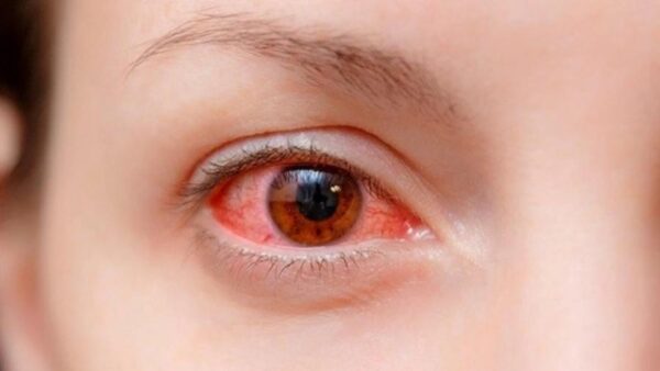 nhận biết đau mắt dỏ
