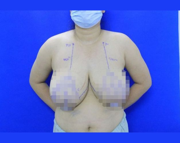 Ngực lớn gấp nhiều lần là một trong những triệu chứng của phì đại tuyến vú