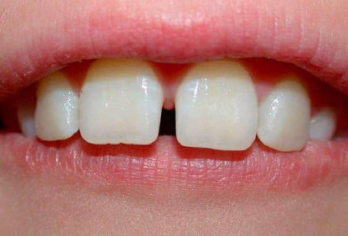 phục hình răng thưa