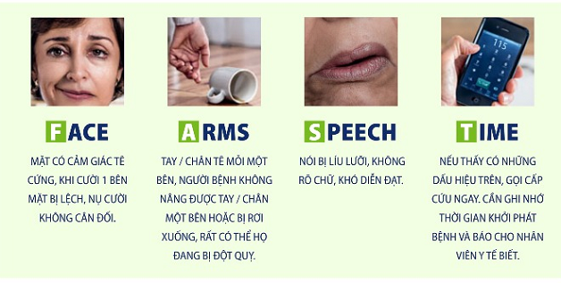 Dấu hiệu nhận biết bệnh đột quỵ có thể thông qua quy tắc F.A.S.T