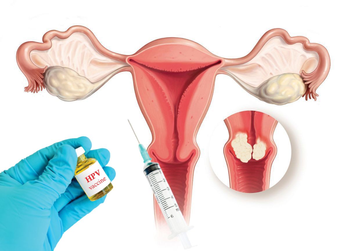 Vắc xin phòng ung thư cổ tử cung giúp giảm nguy cơ lây nhiễm HPV và nguy cơ mắc ung thư cổ tử cung