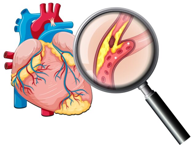 Thiếu máu cục bộ cơ tim ecg làm giảm chức năng tưới máu của tim.