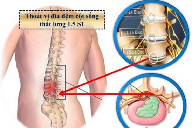 thoát vị đĩa đệm ở hông