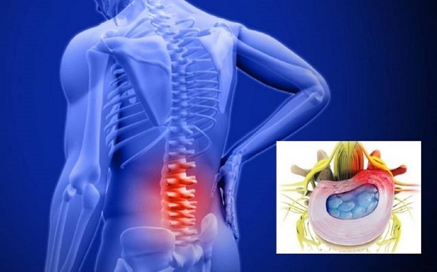 Thoát vị đĩa đệm ở hông