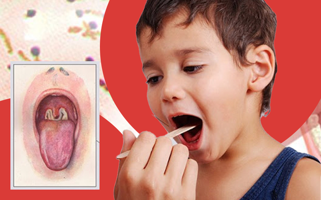 Bệnh bạch hầu là một tình trạng nhiễm trùng nguy hiểm do vi khuẩn Corynebacterium diphtheriae gây ra