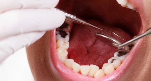 trám và bọc răng sứ