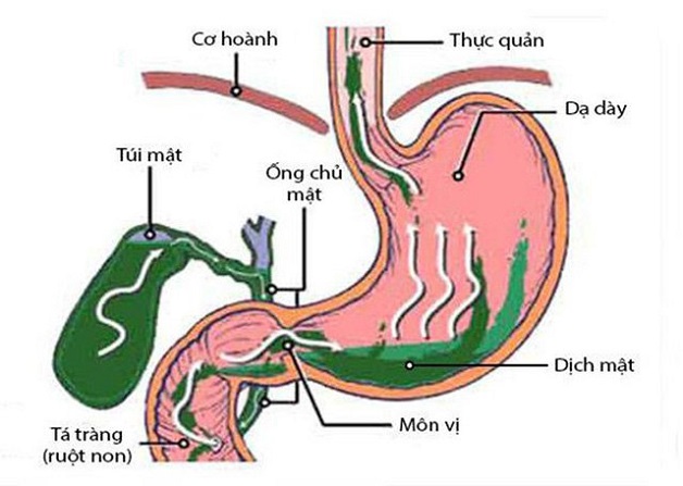 Trào dịch mật là bệnh lý ở hệ tiêu hóa