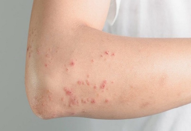 Phát ban, sẩn ngứa là một trong những triệu chứng sốt xuất huyết