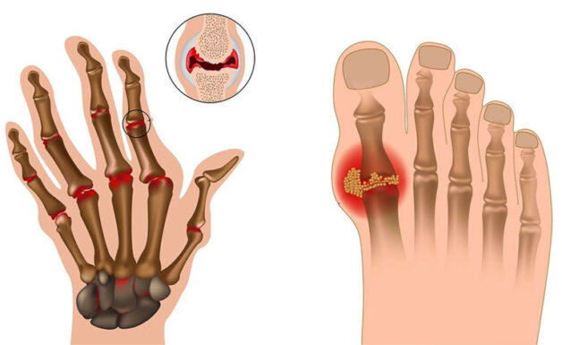 Bệnh gout, viêm khớp dạng thấp làm tăng nguy cơ triệu chứng viêm khớp nhiễm khuẩn xuất hiện