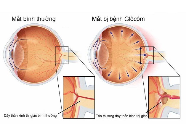 Bệnh tăng nhãn áp