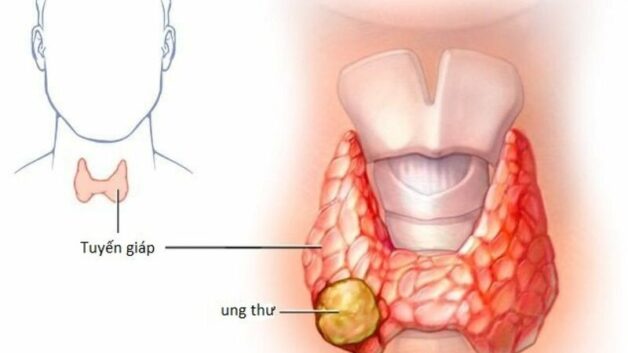 Tuyến giáp nhu mô không đều được xác định qua siêu âm hoặc MRI