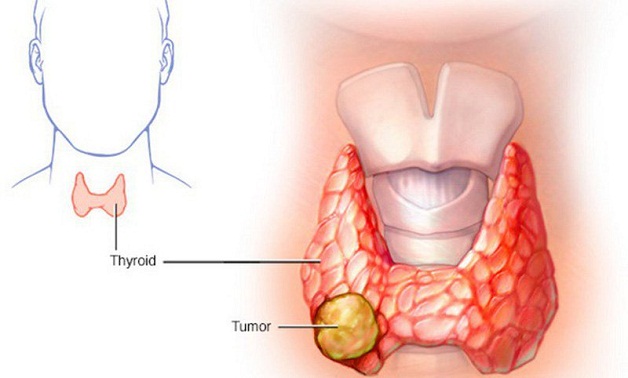 Các bệnh tuyến giáp thường gặp