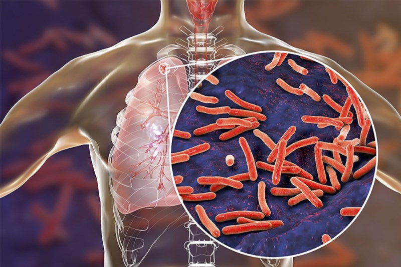 Vacxin lao giúp bảo vệ trẻ khỏi bệnh lao - một bệnh truyền nhiễm gây ra bởi vi khuẩn Mycobacterium tuberculosis