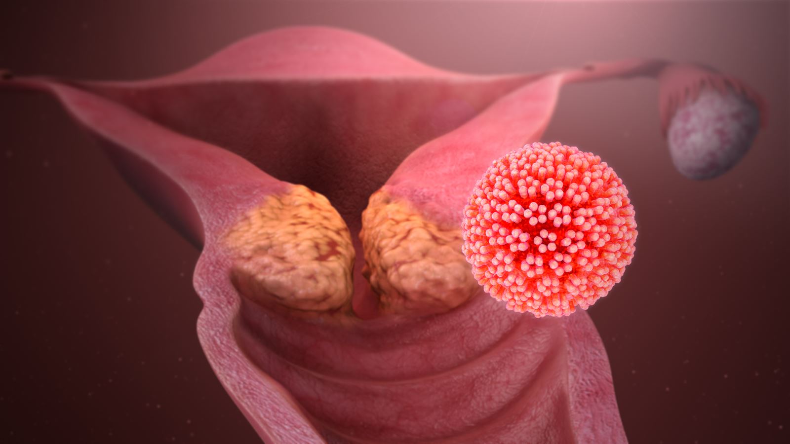 Có tới 90% trường hợp phụ nữ mắc ung thư cổ tử cung có liên quan đến virus HPV