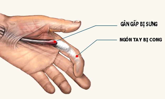 Viêm gân gấp ngón tay hay còn gọi là ngón tay xò súng
