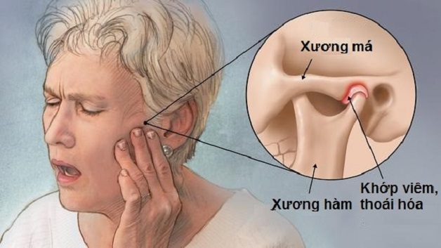 Các bệnh lý về xương khớp gây viêm khớp quai hàm