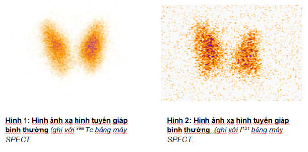 Kết quả xạ hình tuyến giáp