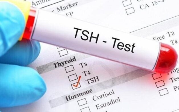 Bác sĩ có thể xét nghiệm bổ sung để phát hiện tình trạng tuyến giáp