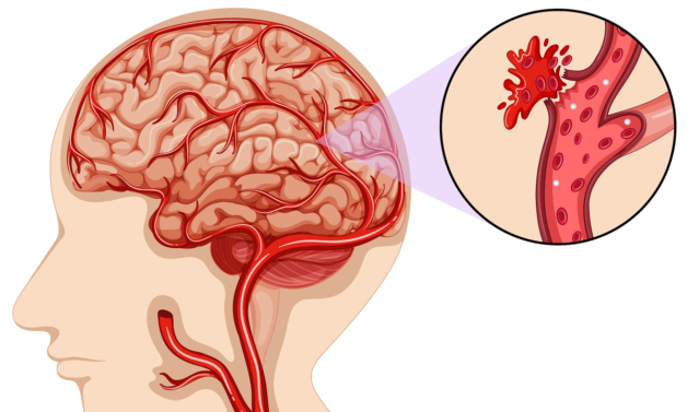 Chảy máu tuyến yên gây đột quỵ não
