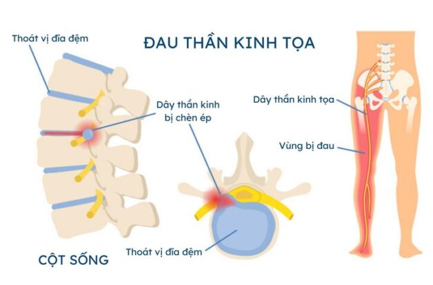 Yoga chữa đau dây thần kinh tọa, cải thiện triệu chứng bệnh