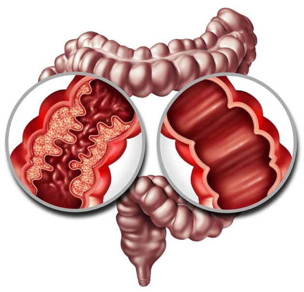 Bệnh viêm ruột tự miễn