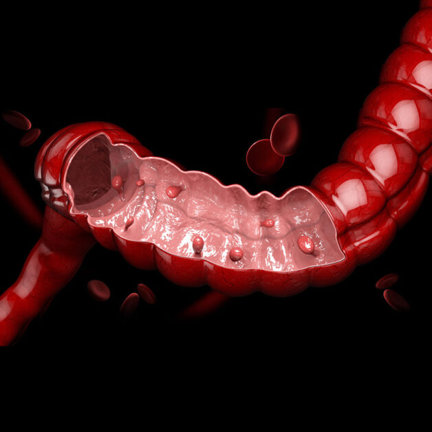 Hình ảnh Polyp đại tràng tuyến