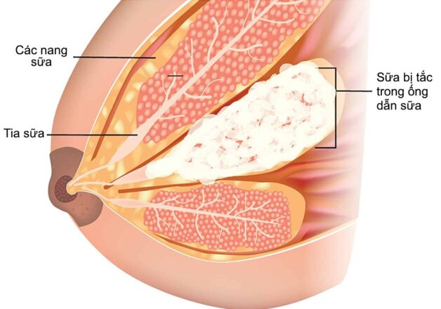Tắc ống dẫn sữa