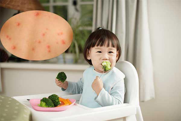 Thủy đậu nổi nhiều trên mặt trẻ cần được xử trí thật cẩn thận-3