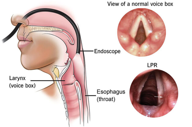 Trào ngược dạ dày gây nghẹt mũi và viê thanh quản