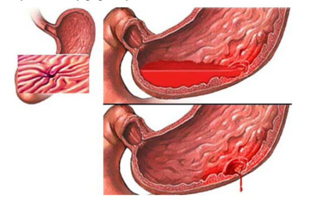 Viêm ruột xuất huyết