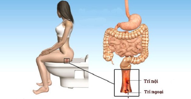 Bệnh trĩ gây ra nhiều phiền toái cho người bệnh