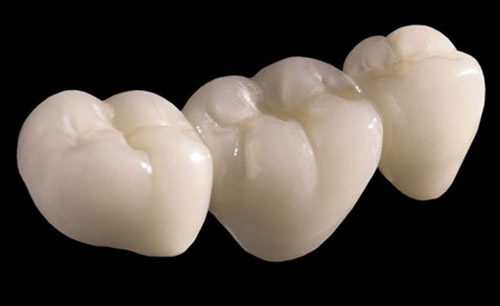 bọc răng sứ đắt không