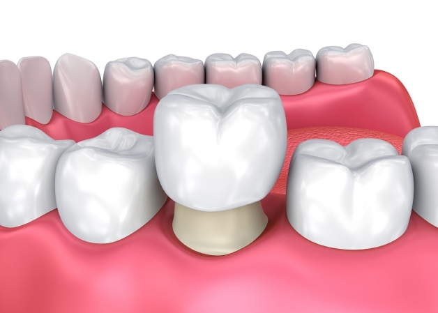 bọc răng sứ ưu nhược điểm