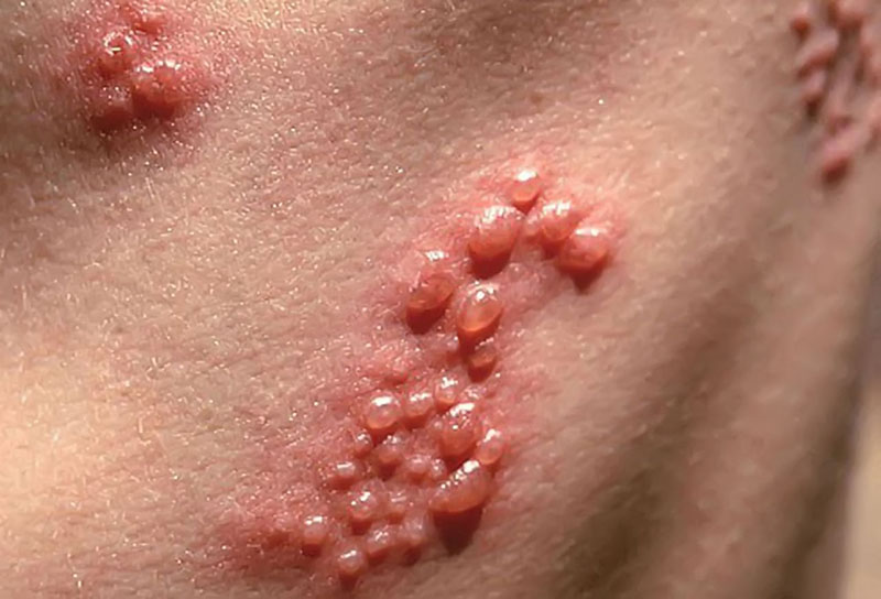 Mắc herpes sinh dục sẽ gây ra các đốm mụn sưng đau tại vùng kín