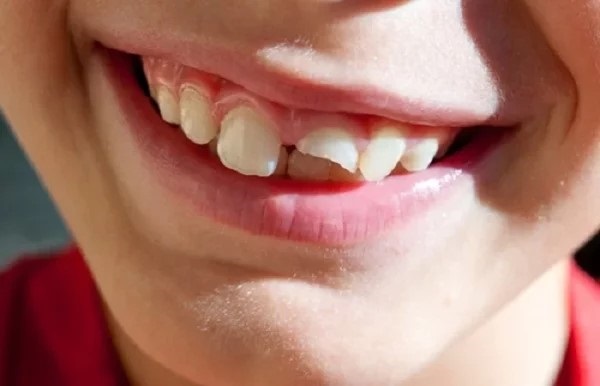 Xử lý răng gãy tại nhà là giải pháp tạm thời