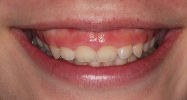 chi phí phẫu thuật cười hở lợi