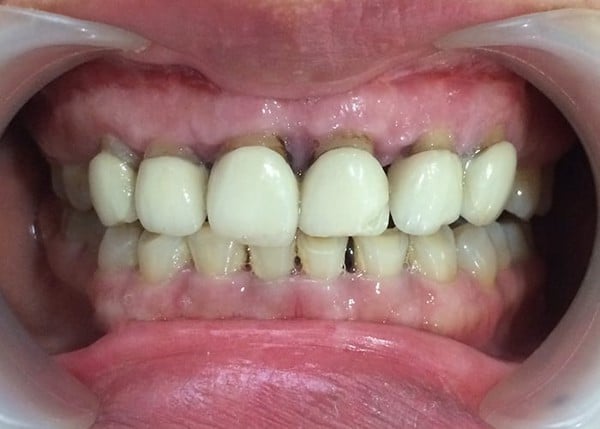 Hậu quả gia tăng nguy cơ viêm nướu, hôi miệng
