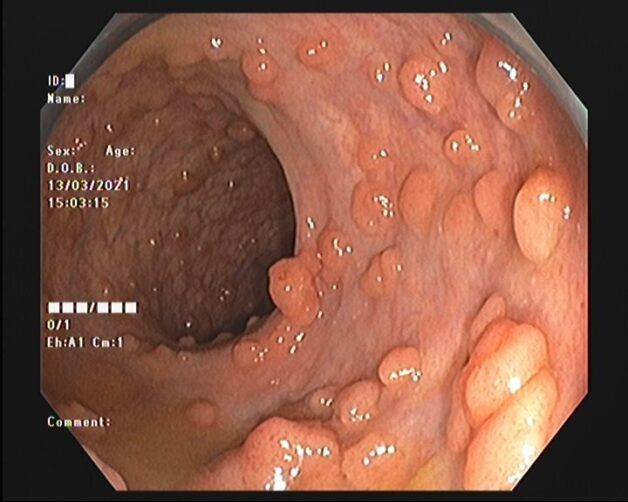 Hình ảnh đa polyp đại tràng gia đình