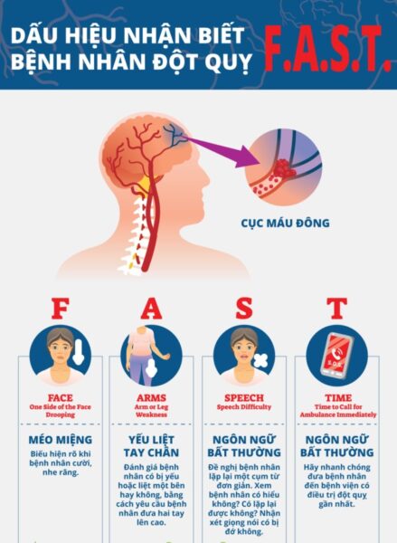 Nguyên tắc FAST trong nhận biết đột quỵ