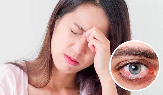 Bất kỳ ai cũng có thể mắc phải đau mắt đỏ, kể các mẹ bầu