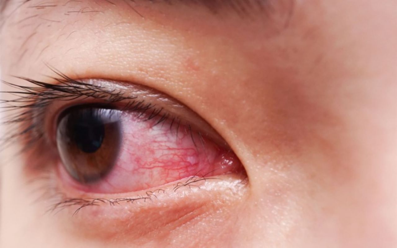 Đau mắt đỏ là một căn bệnh thường gặp do nhiễm trùng từ vi khuẩn, virus hoặc các tác nhân gây dị ứng trong môi trường