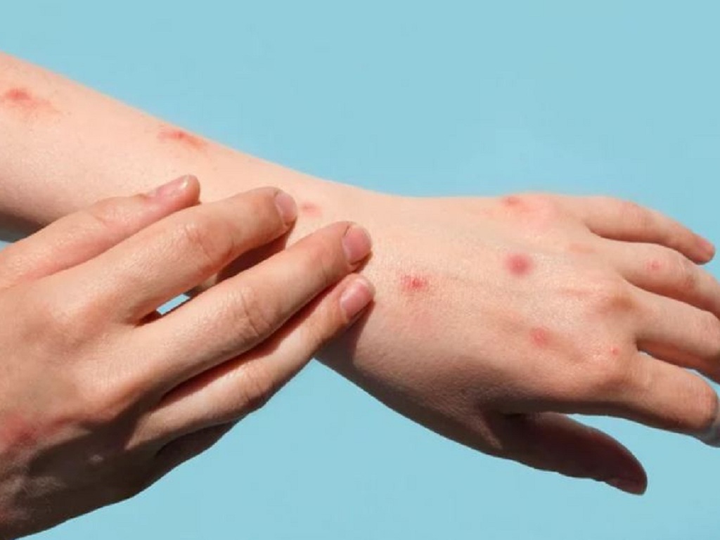 Bệnh đậu mùa khỉ xuất hiện ở người với các triệu chứng ban đầu như sốt, sưng hạch, phỏng nước