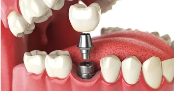địa chỉ cấy ghep implant tốt