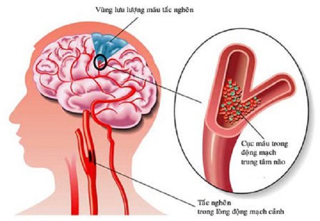 Đột quỵ hay còn gọi là tai biến mạch máu não, cực kỳ nguy hiểm đến tính mạng con người