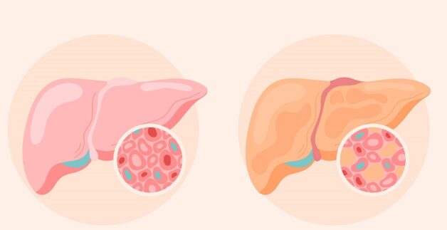 Bệnh gan nhiễm mỡ là gì? Bệnh gan nhiễm mỡ có 3 cấp độ chính trong đó cấp độ 3 là nguy hiểm nhất