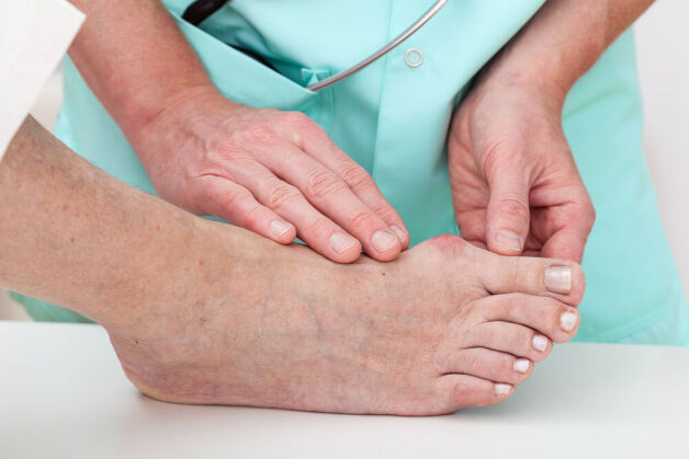 Thăm khám và điều trị sớm làm tăng kết quả điều trị viêm gout cấp tính