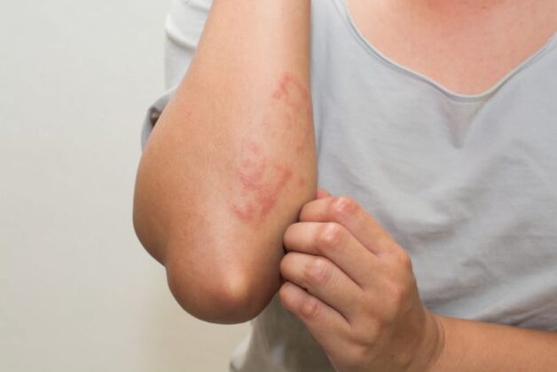 Lá vối chữa bệnh gan nhiễm mỡ, cải thiện triệu chứng nóng gan