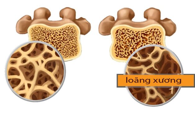 Điều trị loãng xương là cải thiện tình trạng mật độ xương thừa dần